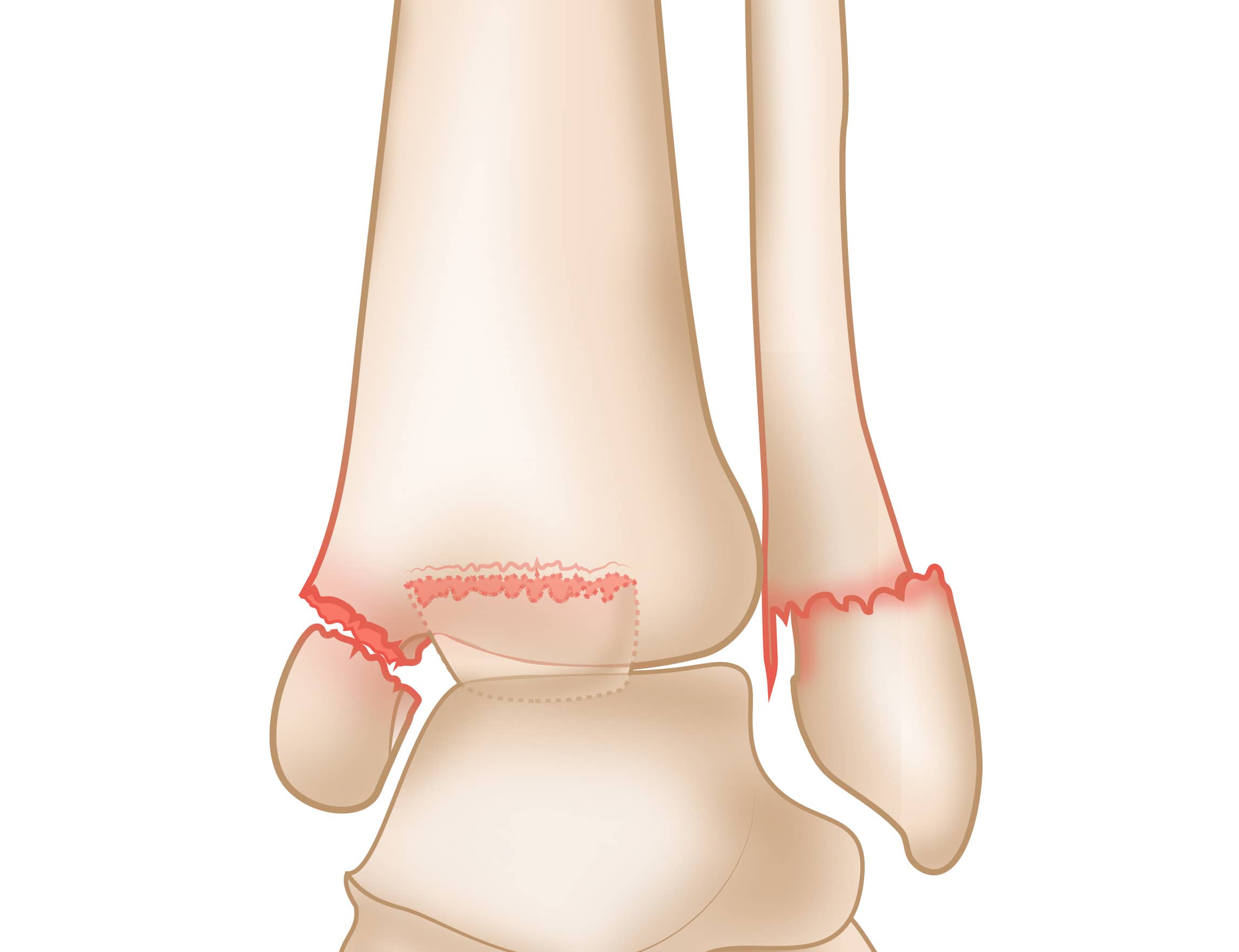 Trimalleolar Fracture