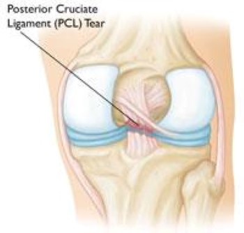 Knee Ligament Injuries