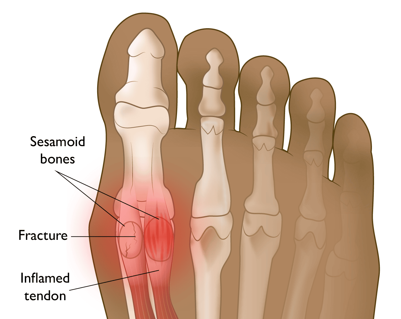 Sesamoid Fracture and Sesamoiditis