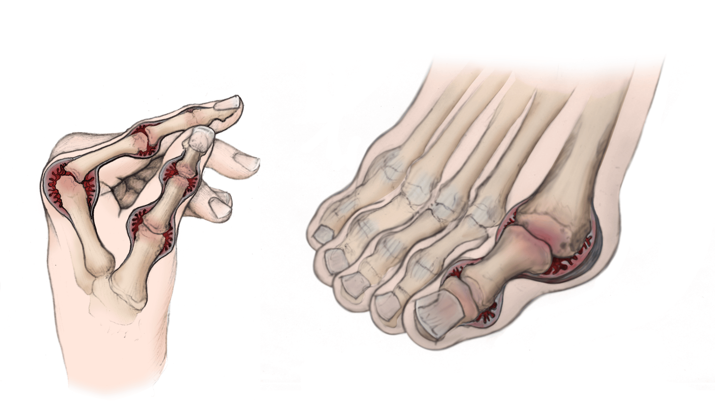 Effects of Rheumatoid Arthritis: Skeletal System, Immune, More