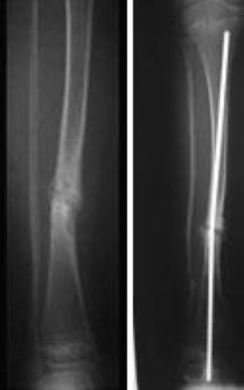 Pseudoarthrosis of the tibia