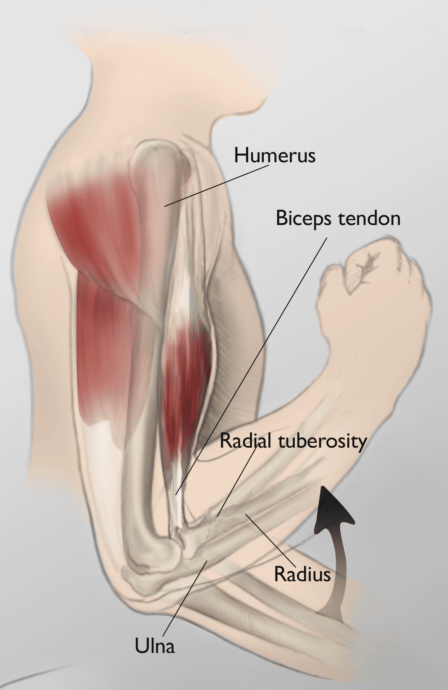 Ruptured biceps outlet tendon