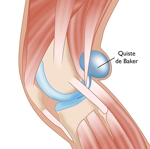 Quiste de Baker (quiste poplíteo) (Baker's Cyst (Popliteal Cyst)) -  OrthoInfo - AAOS