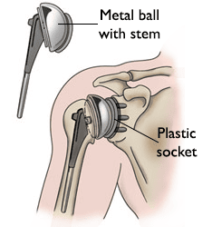 Arthritis of the Shoulder - OrthoInfo - AAOS