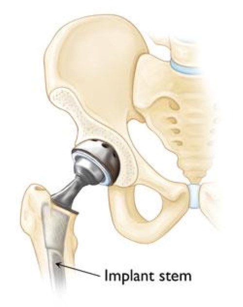 What is involved with Partial Hip Replacement Recovery?