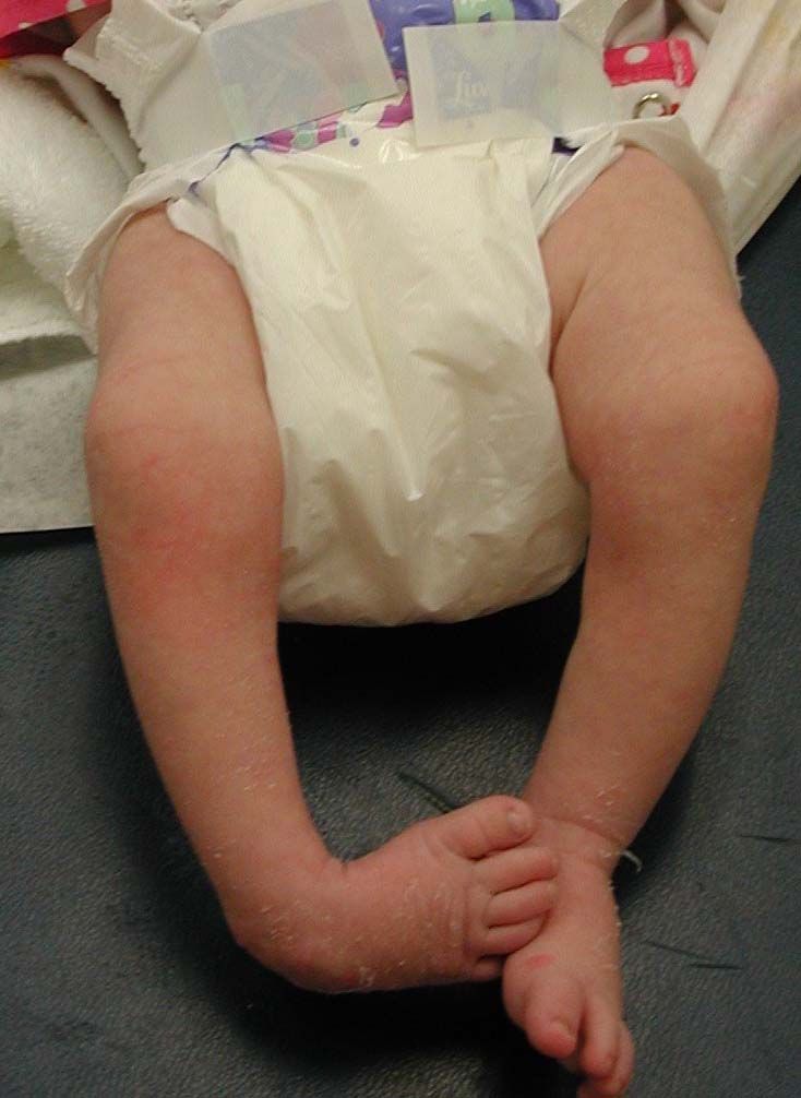 What Is Clubfoot? - Symptoms and Treatment