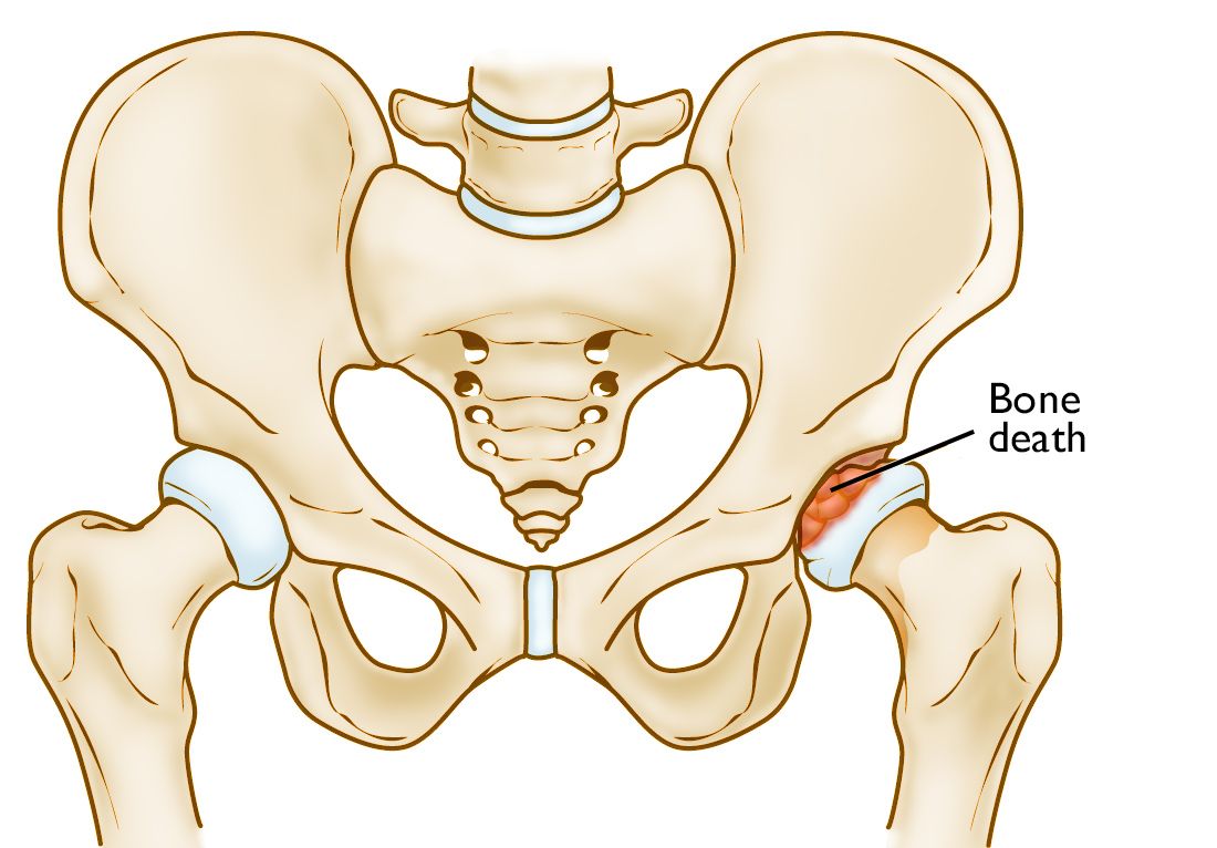 Ostenecrosis