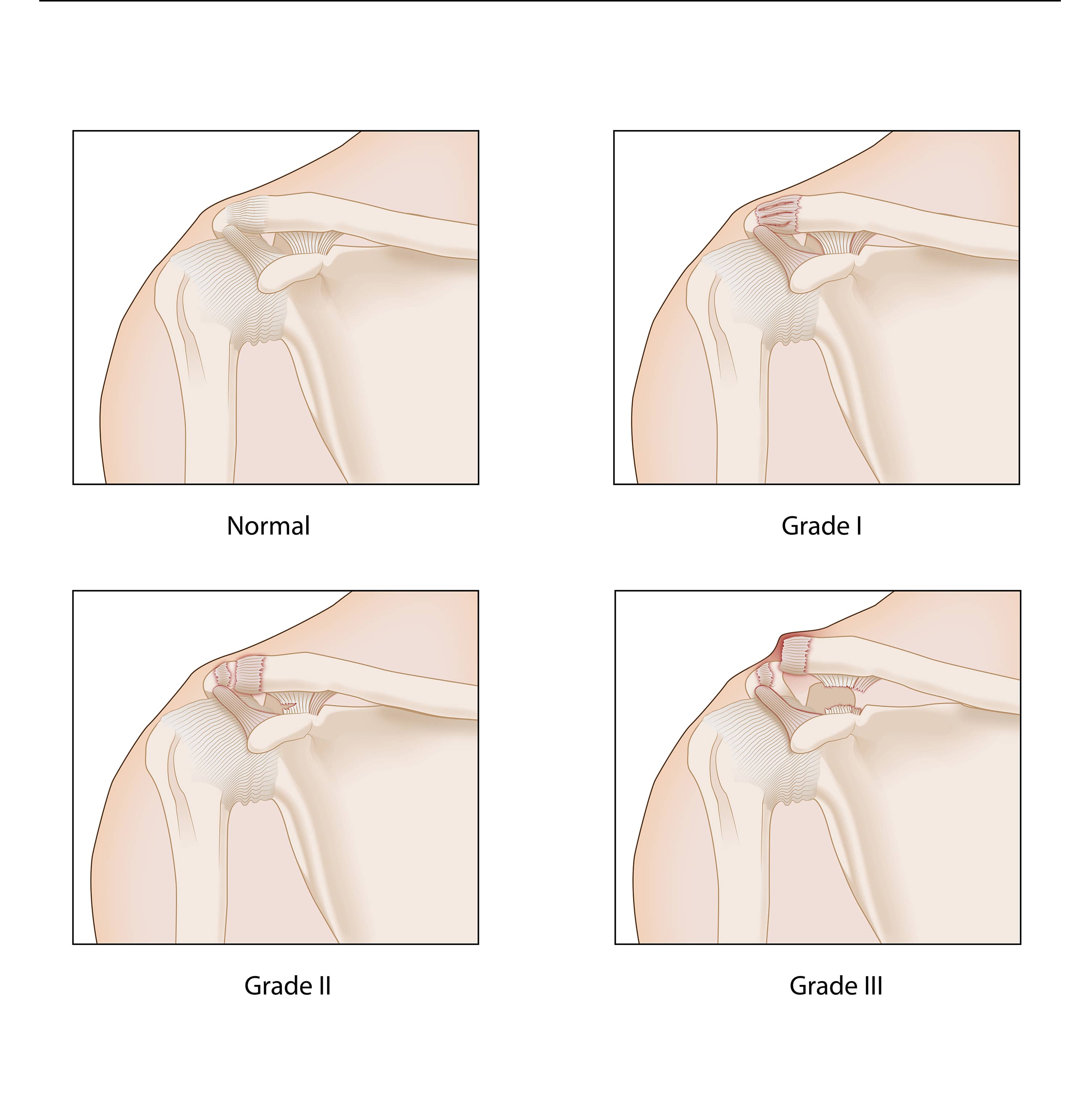 Grades of Shoulder Separation