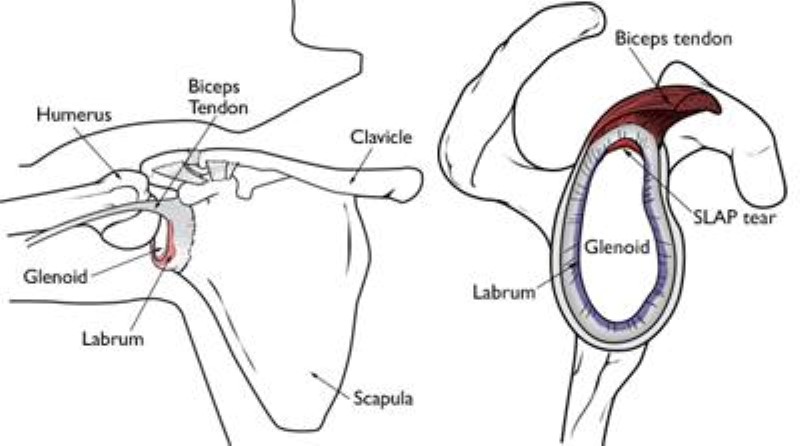 labrum del hombro y rotura SLAP