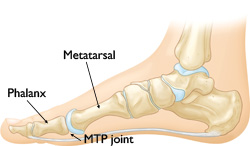 Hallux Rigidus (Stiff Big Toe) - OrthoInfo - AAOS