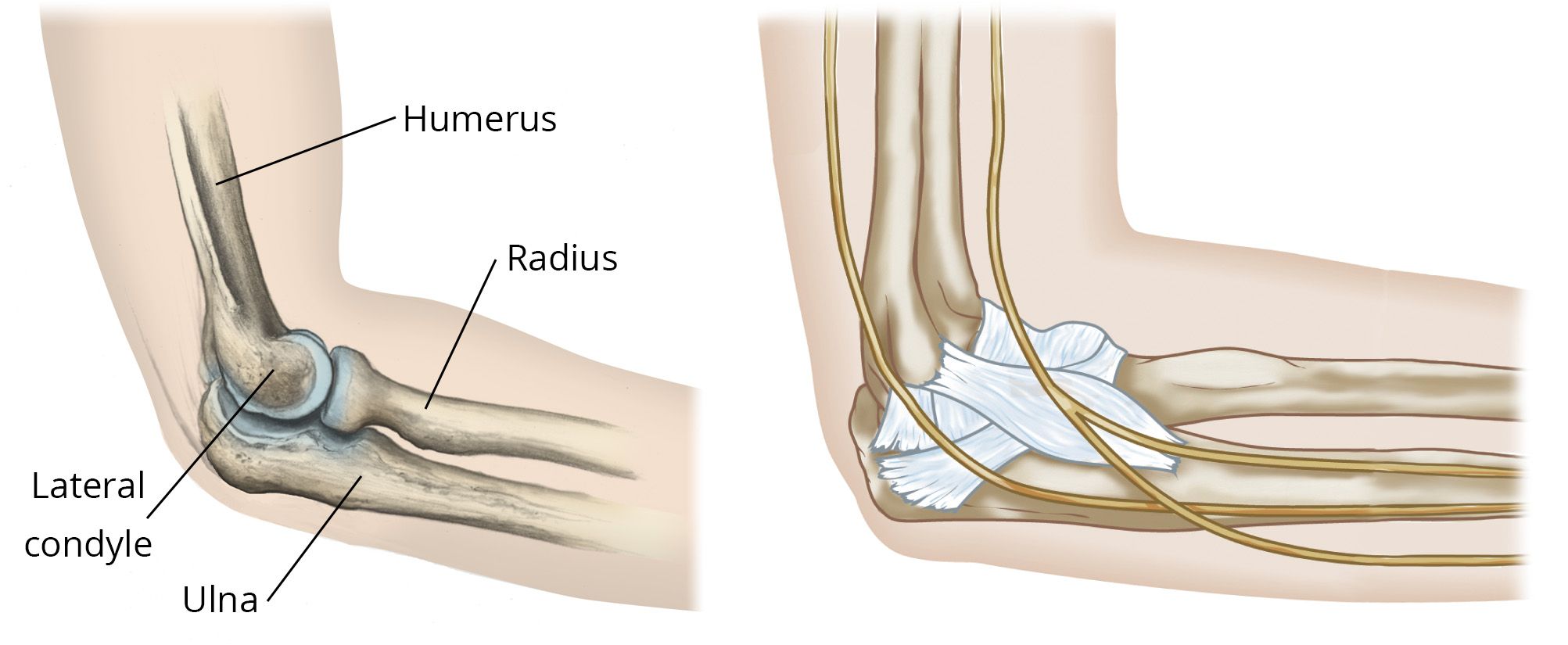 elbow fracture cast