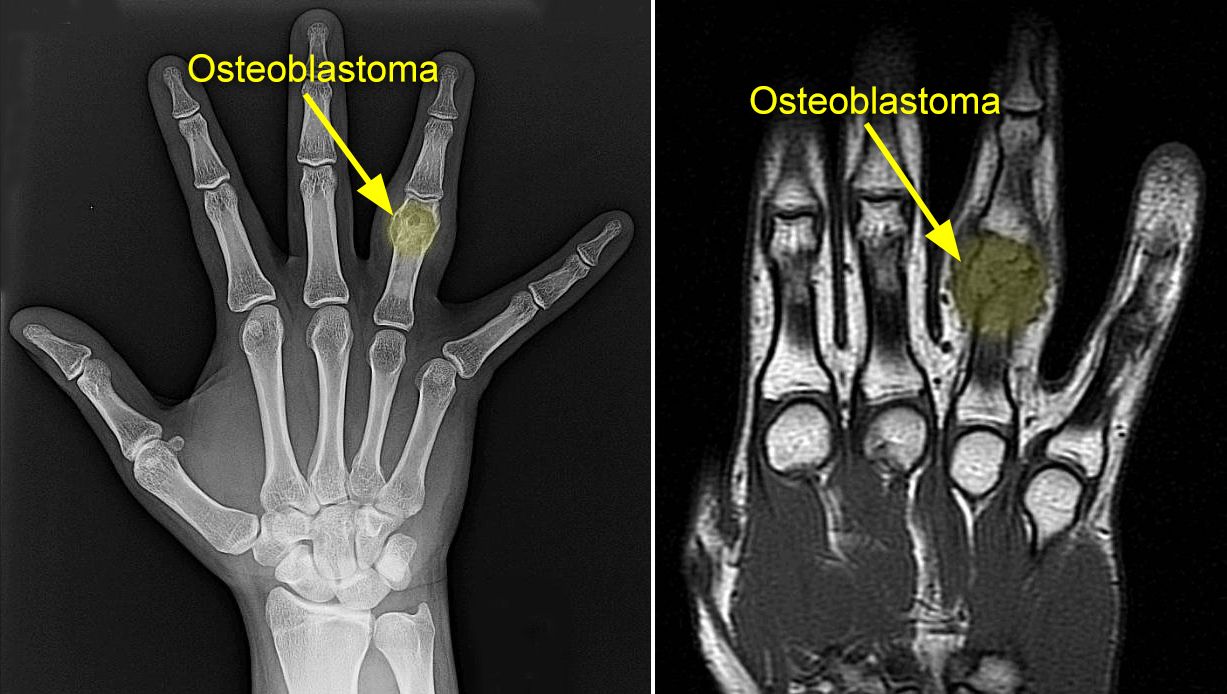 x-ray and mri of osteoblastoma
