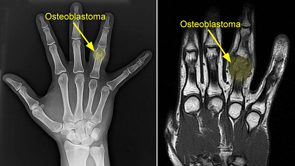 osteoid osteoma spine mri