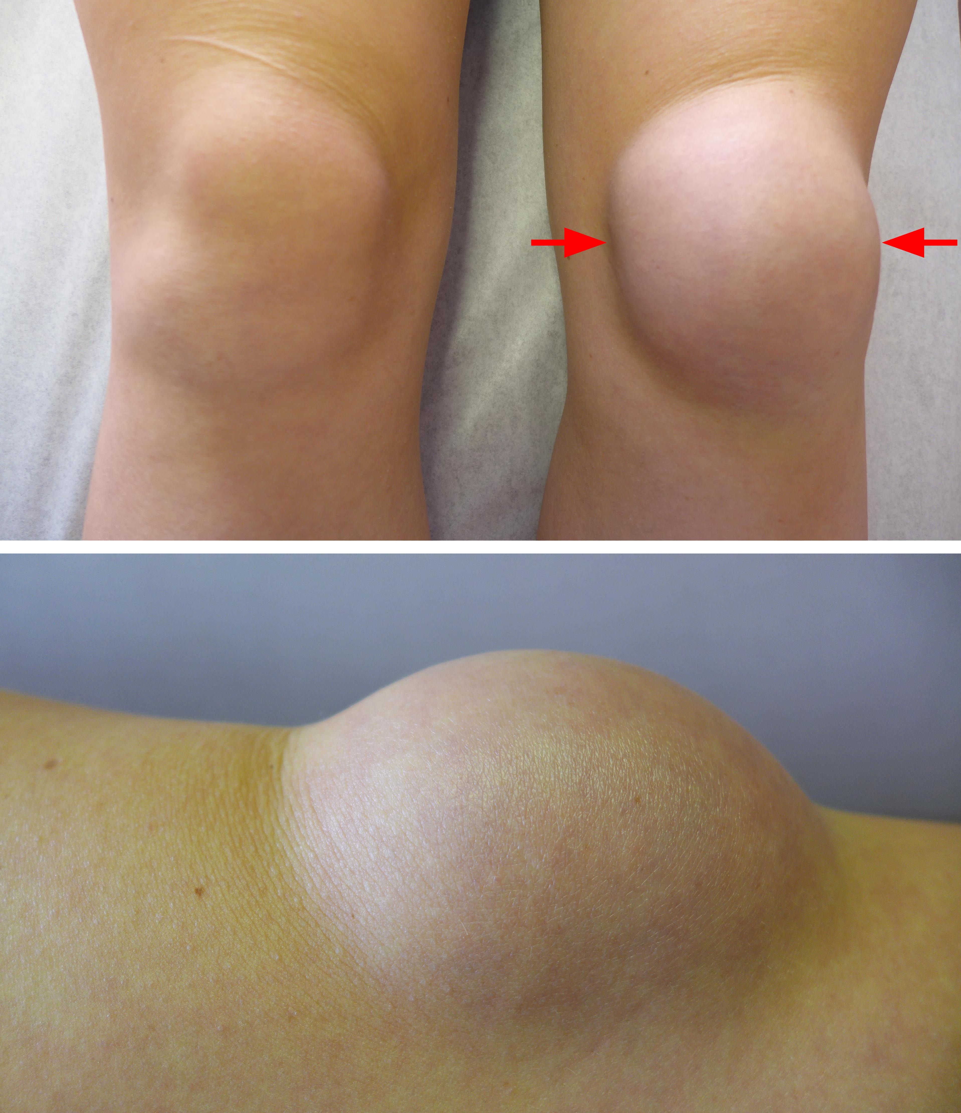 inflammation of the knee cap