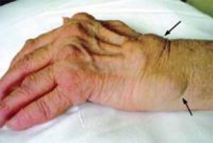 Rheumatoid arthritis