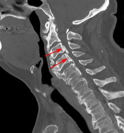 CT scan showing narrowing of the spinal canal due to bone spurs