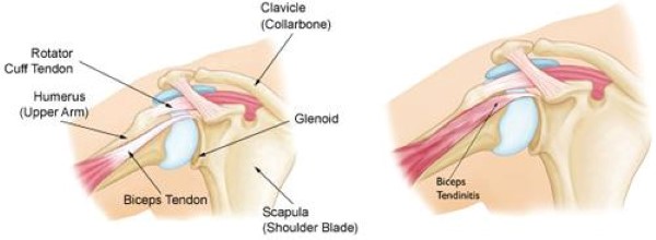 tendinitis del bíceps