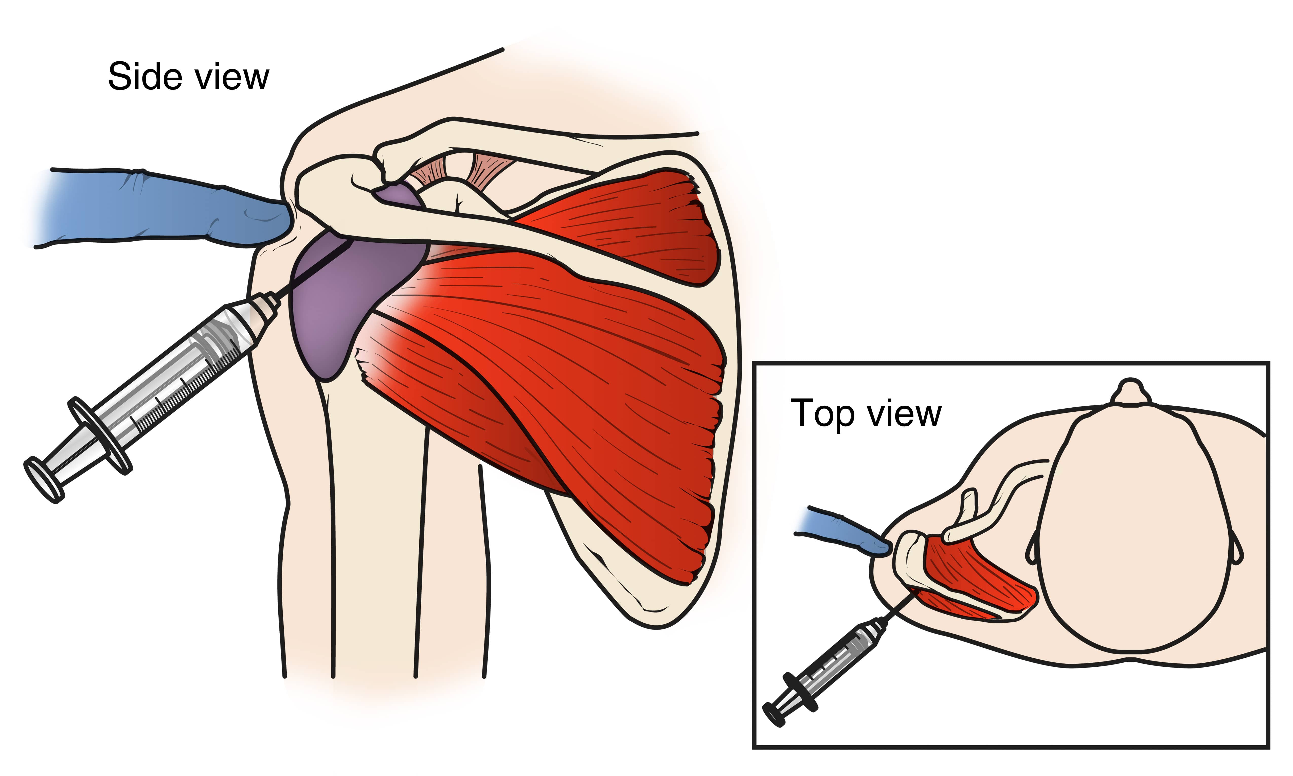 Shoulder Pain, Injuries, Treatment