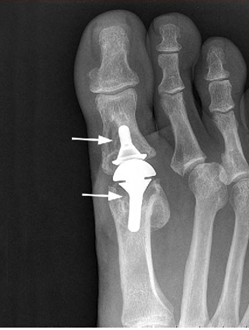 Blackmer Foot & Ankle  Hallux Rigidus Big Toe Joint Arthritis) in Meridian