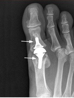 Arthroplasty for Hallux Rigidus