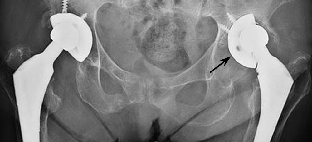 Revision Total Hip Replacement - OrthoInfo - AAOS