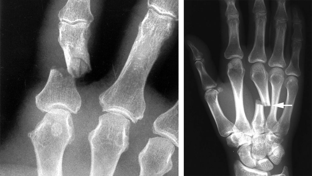 hand bones xray