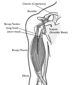 ripped bicep tendon