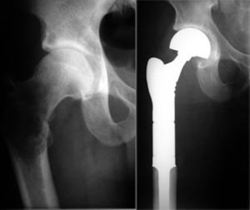hip replacement for metastatic bone disease