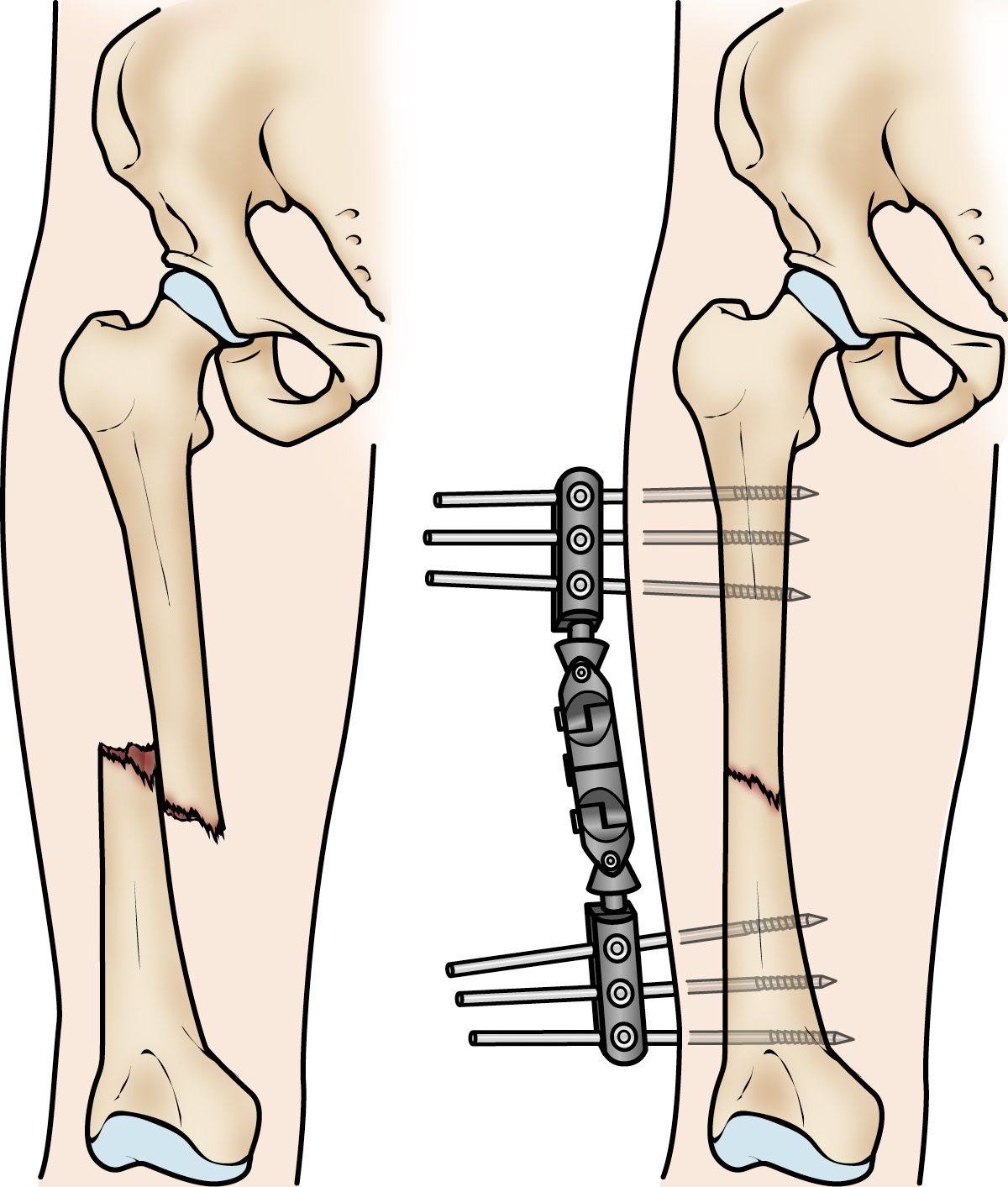 Fracturas De La Di Fisis Femoral Ruptura Del Hueso Del Muslo Femur Shaft Fractures Broken