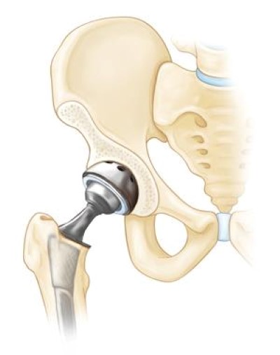 Hip replacement implants