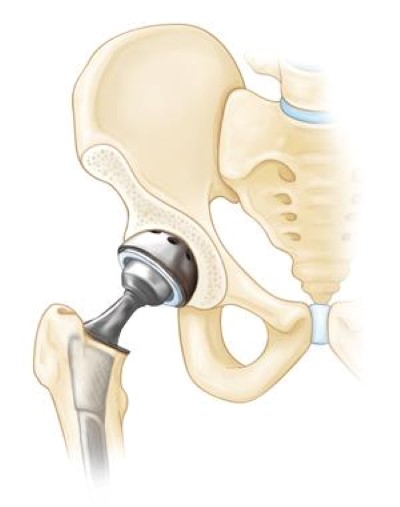 Hip Osteoarthritis - OrthoInfo - AAOS