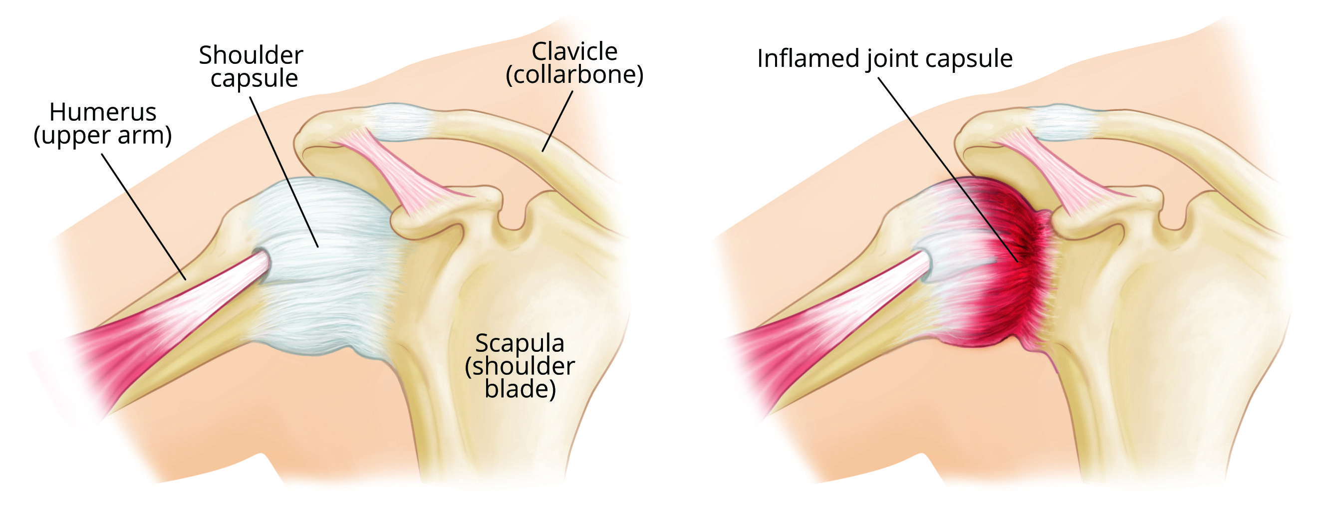 Inflamed joint capsule