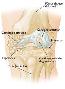 Cómo curar la artrosis de rodilla