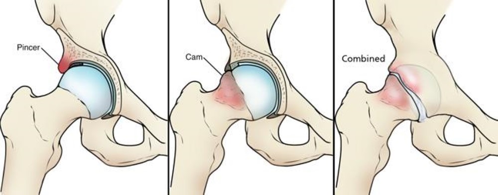 Femoroacetabular Impingement - OrthoInfo - AAOS