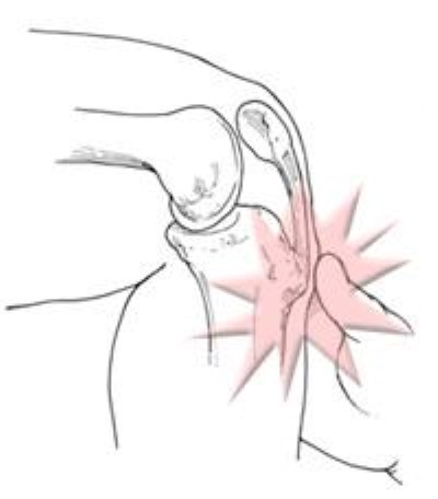 Tuberculose da tíbia inflamada de Osgood-Schlatter