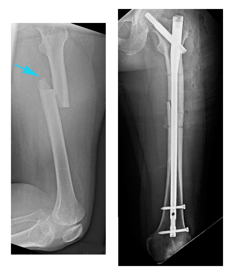 péndulo superávit inyectar Fracturas de la diáfisis femoral (ruptura del hueso del muslo) (Femur Shaft  Fractures (Broken Thighbone)) - OrthoInfo - AAOS