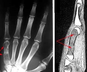 Radiografía y resonancia magnética de encondroma en la mano