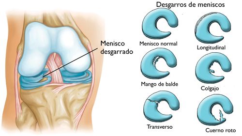 Tipos de Lesiones de Rodilla y Tratamientos ¿Cuándo ir al médico? –