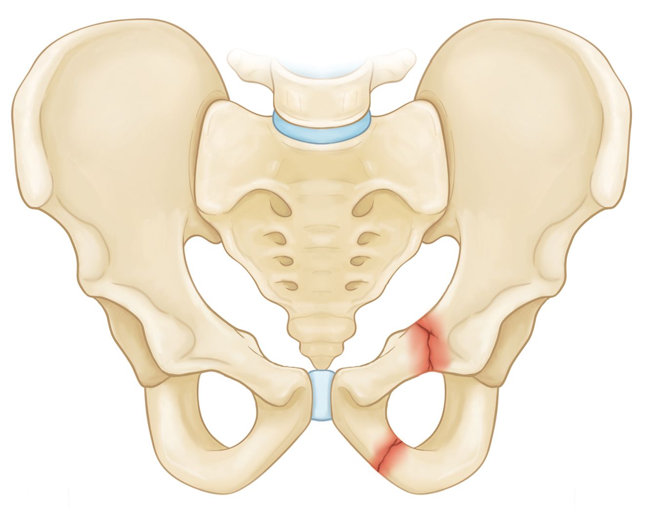 superior pubic ramus fracture