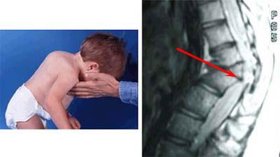 Foto clínica y resonancia magnética de un niño con cifosis congénita
