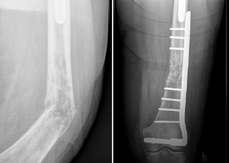 Internal fixation of pathologic fracture