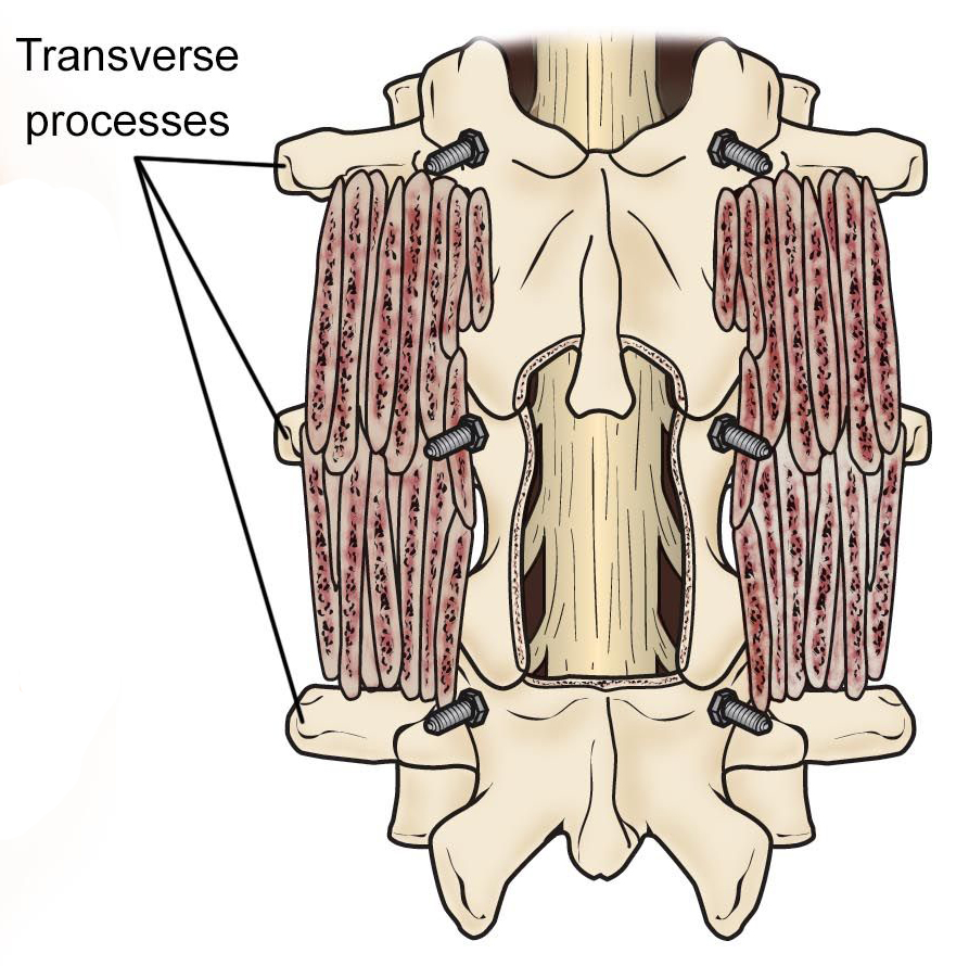 List 93+ Pictures Lumbar Spinal Fusion Surgery Pictures Updated 10/2023