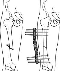 External fixation