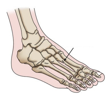 Ankle Fractures In Children - OrthoInfo - AAOS