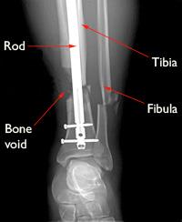 tibia bone rod orthobiologics fixation metal orthoinfo broken aaos internal help gap void shinbone ray shows been