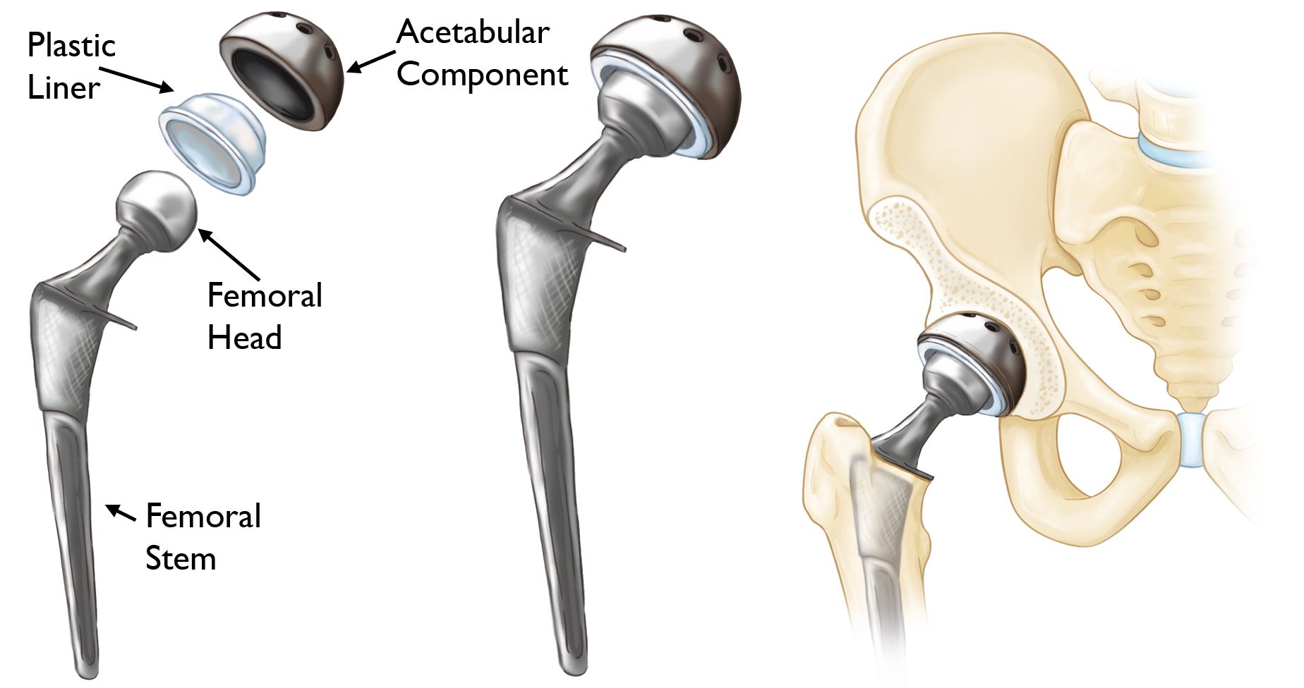 Minimally Invasive Total Hip Replacement - OrthoInfo - AAOS