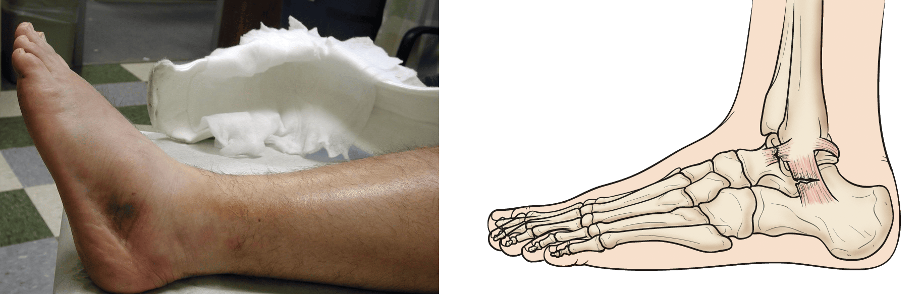 A Guide to Ankle Sprains