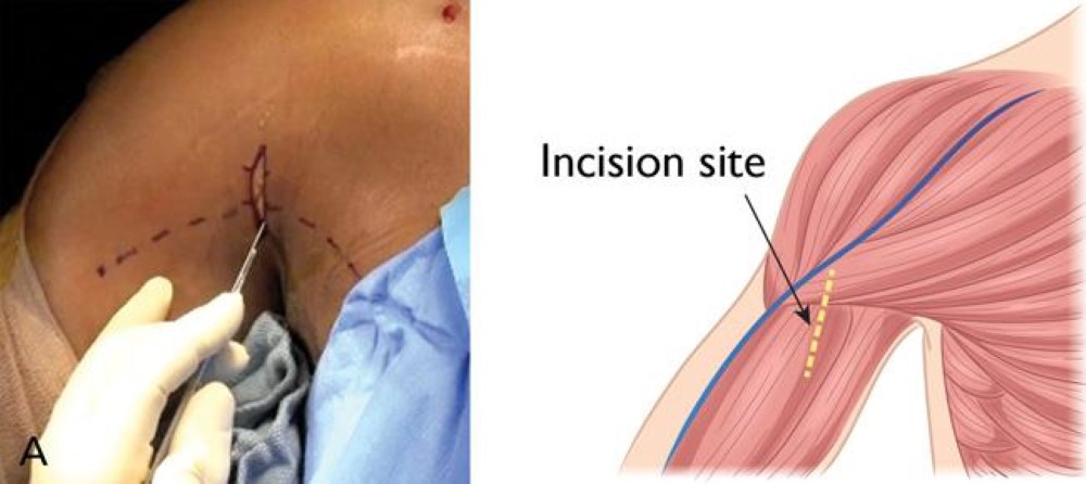 Incisión para tenodesis del bíceps. 