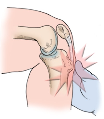 Pain below knee cap store on bone