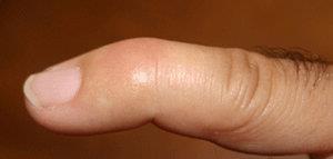 Mallet finger